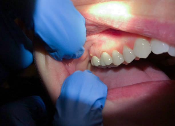 Best Emergency Wisdom Teeth Removal in Corry, PA